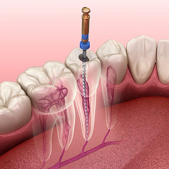 Lower Gwynedd Endodontics -